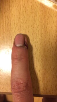 指がパックリ割れてしまいました 数ヶ月前からささくれができ 皮膚 Yahoo 知恵袋