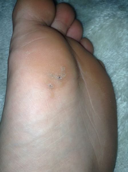 水虫 解決済みの質問 Yahoo 知恵袋