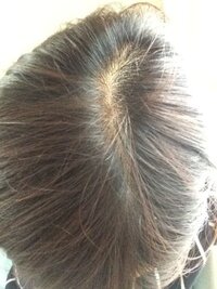 この薄毛はやばいですか 画像ありです 30代後半の女性です 脂漏 Yahoo 知恵袋