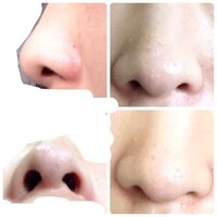 ブタ鼻を治すには整形しかないんでしょうか 男性ですが 豚 Yahoo 知恵袋