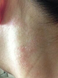 香水等でかぶれたりしますか 首筋がこんな風になってしまいました 思い当たる Yahoo 知恵袋