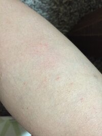 足に小さなプツプツが出来 困っておます これはダニなど虫刺されの Yahoo 知恵袋