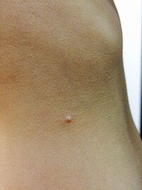 子供5歳幼稚園年長が 画像のような出来物が４箇所あります Yahoo 知恵袋