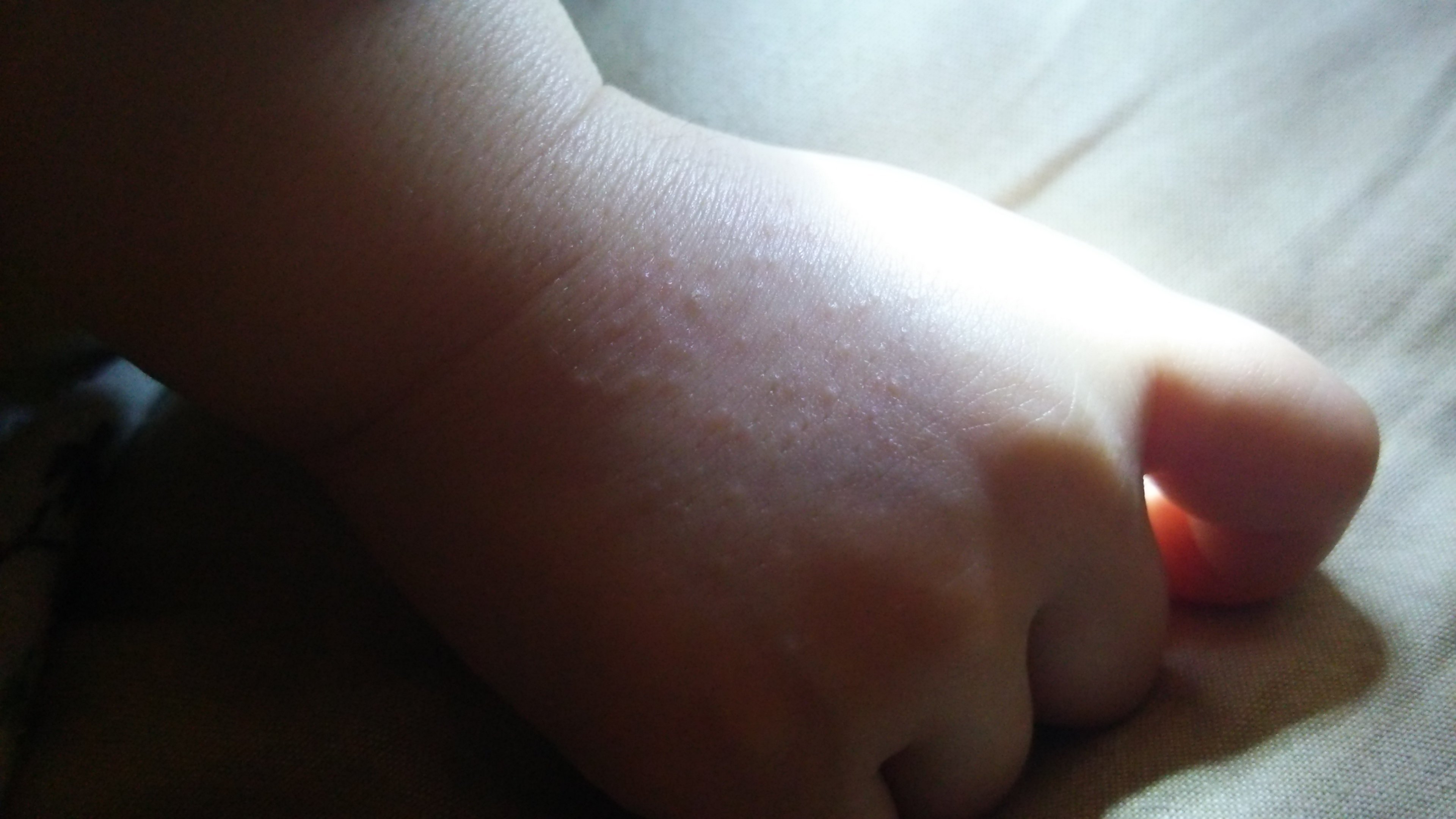 子供はアトピーなんですが 手の甲に光沢のある丘疹がたくさんできます こ Yahoo 知恵袋
