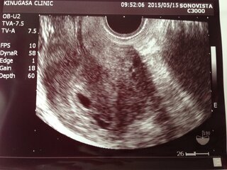 双子妊娠 エコー写真ありです 今 4週5日の妊婦です 先日 産婦人科を受診 Yahoo 知恵袋