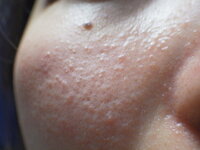 ザラザラ ブツブツ 顔 肌がザラザラする原因と対策│なめらか肌づくりの方法も紹介