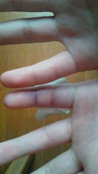 今日 バスケで突き指しました 第一関節と第二関節が紫色になっています Yahoo 知恵袋