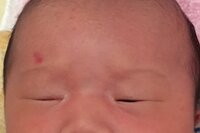 10日に出産した娘の顔に赤いものができてなかなか治りません 誰か Yahoo 知恵袋