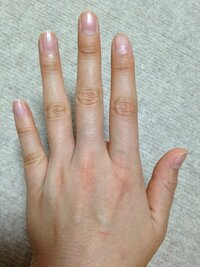 小指が短いです 短指症と言うのを見つけましたが 何か問題があるの Yahoo 知恵袋