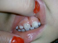 子どもの歯のことですが 前歯２本が他の歯の色と違うことに最近気が Yahoo 知恵袋
