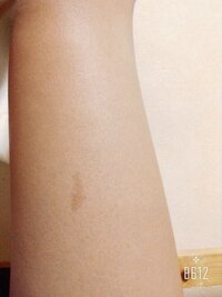 太ももにシミがあります 多分日焼けかなにかでできました消す方 Yahoo 知恵袋