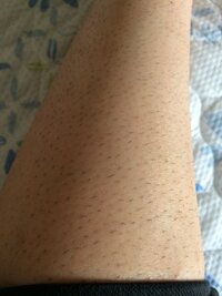 19の女です この毛深さは異常ですか 剃って3日目です 脱毛を考えてい Yahoo 知恵袋