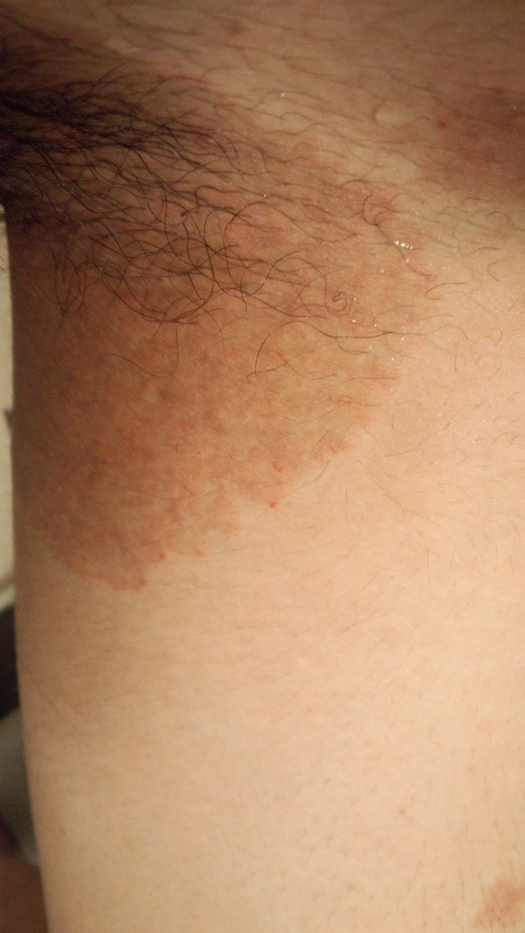 いんきんたむし 画像あり 閲覧注意1月ほど前に太股の付け根あたりに 小さ Yahoo 知恵袋