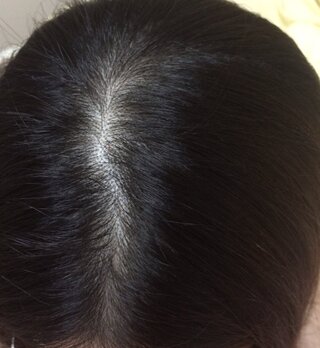 これははげているんでしょうか 20代前半女です 最近分け目とつむじ 生え際 Yahoo 知恵袋