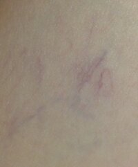 足に糸が絡まったような血管があるのですがこれは何ですか 当方看護師で Yahoo 知恵袋