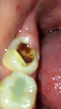 虫歯でしょうか 痛いです 歯医者が怖いです どんな感じに治療しますか Yahoo 知恵袋