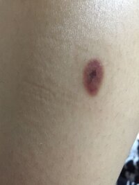 1ヶ月前にほくろ除去したのですがコレって治っているんでしょうか Yahoo 知恵袋