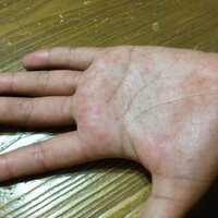赤ちゃんで両手の手のひらが皮がむけています お風呂上りにふやけて白 Yahoo 知恵袋