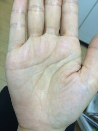 手のひらの真ん中がムズムズします 右手が落ち着いたら 左手がムズムズしてい Yahoo 知恵袋