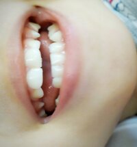 ２歳で八重歯が生えることってあるんでしょうか 夫が八重歯がありず Yahoo 知恵袋