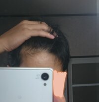 片方の生え際が気になるのですがこれってハゲの前兆ですか 片方のそ Yahoo 知恵袋