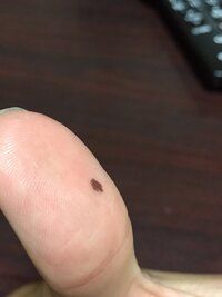 指にホクロらしいものが急にできたので驚いています 画像の通りです 形が歪な Yahoo 知恵袋