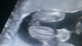 妊娠６ヶ月目のエコー写真です 性別判断をお願いします 女の子っぽいで Yahoo 知恵袋