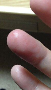 指に出来た水泡 の痒みと痛み 指の腹に透明な水泡のようなもの Yahoo 知恵袋