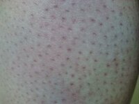 足の毛穴について 高校生です 足に毛穴のプツプツがめっちゃあります Yahoo 知恵袋