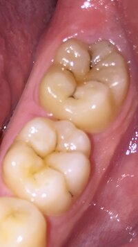 これは虫歯ですよね 先月歯医者に行ってきたのですが 歯医者さんに 黒くなっ Yahoo 知恵袋