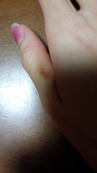 １ヶ月程前から親指が変色して元の色に戻りません 痒い 痛いなどの Yahoo 知恵袋