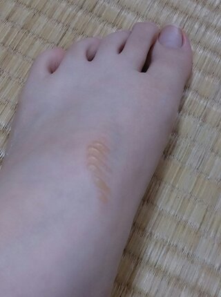 足にテーピングをしたら 写真のように甲の部分に水ぶくれができてしまいました Yahoo 知恵袋