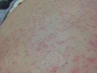 薬疹が出てこまってます 整形で処方されたセレコックス100mg内科で処方さ Yahoo 知恵袋