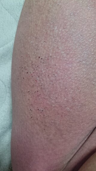 これは蕁麻疹ですか 写真を拡大してみたら 典型的な サメ肌 Yahoo 知恵袋