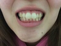 前歯が大きいのが悩みです 前歯2本が大きく ニコッと笑うと前歯が目 Yahoo 知恵袋