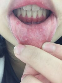画像の閲覧注意です ピンサロ嬢です 下唇に口内炎のようなものがいくつもでき Yahoo 知恵袋