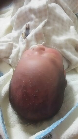 赤ちゃんの頭皮にふけ が 生後１ヶ月の赤ちゃんですが 毎日石鹸で Yahoo 知恵袋
