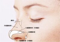 鼻骨骨折して１週間以上経ちますが 鼻に変形が見られません 手術すべきでし Yahoo 知恵袋