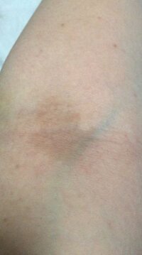 左肘の内側の皮膚が変色しているのですがなぜでしょうか 写真あり Yahoo 知恵袋