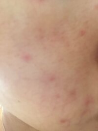 これは湿疹ですか アトピー持ちです 今回もアトピーによる湿疹かと思いステロ Yahoo 知恵袋