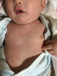 保湿したら乳児湿疹が悪化する3ヶ月の赤ちゃんなんですが 乳児湿疹が出てい Yahoo 知恵袋