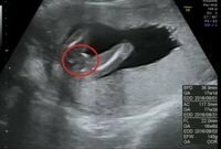 １７週の赤ちゃんエコー画像です 男の子か女の子かわかりますか 先生は女の子 Yahoo 知恵袋