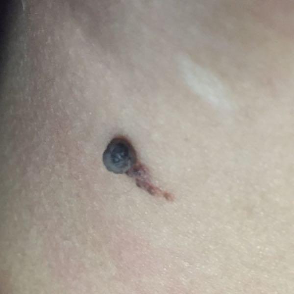 メラノーマ 脇腹 に関するq A Yahoo 知恵袋