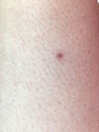 私は夏に足にニキビができてからその跡が残っています それをなくし Yahoo 知恵袋