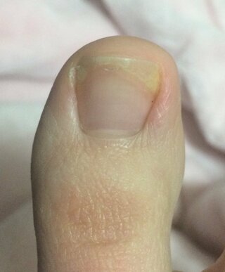 右足の親指なんですが これって爪甲剥離症ですかね 巻き爪 ではない Yahoo 知恵袋