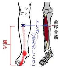 前脛骨筋のこりをすぐとってくれる先生がいる治療院知ってる方いませんか Yahoo 知恵袋