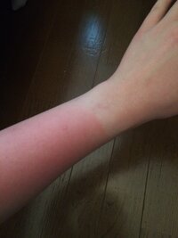大至急お願いします 昨日 腕を日焼けしてしまい 一部分だけとても真っ赤 Yahoo 知恵袋