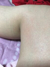 これって何の症状ですか 膝の内側が服と肌が擦れて痛いのと赤 Yahoo 知恵袋