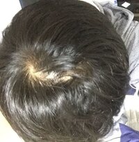 21歳大学３回生です 私にはつむじが二つあり 最近頭頂部の薄さに気に Yahoo 知恵袋