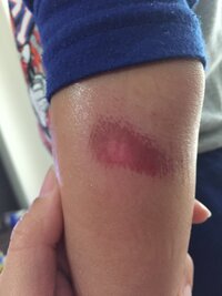 ５歳の息子ですが 2日前に転んで肘あたりに擦り傷ができました 水 Yahoo 知恵袋